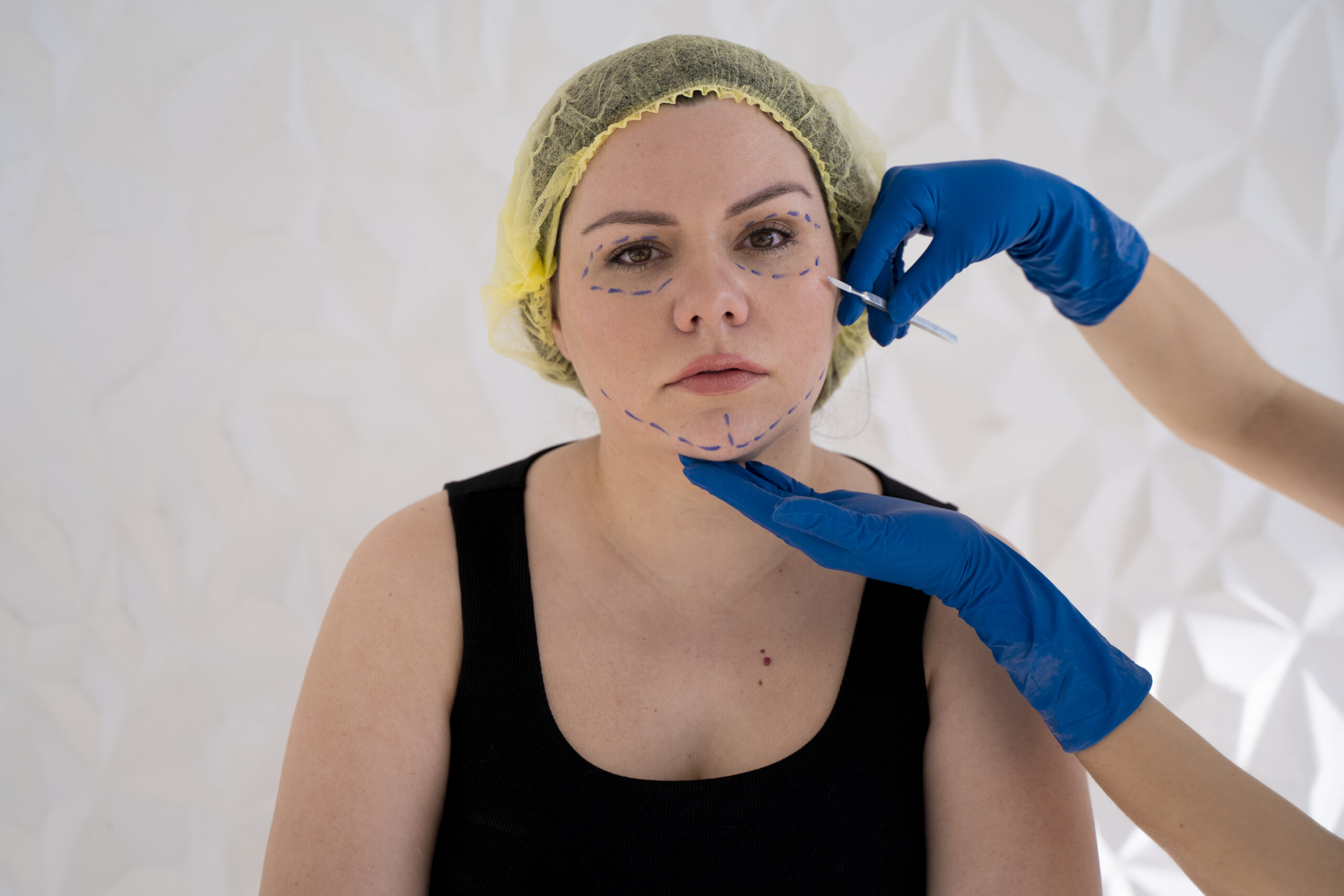 Asimetrik Yüz Ameliyatı ( Profiloplasti )