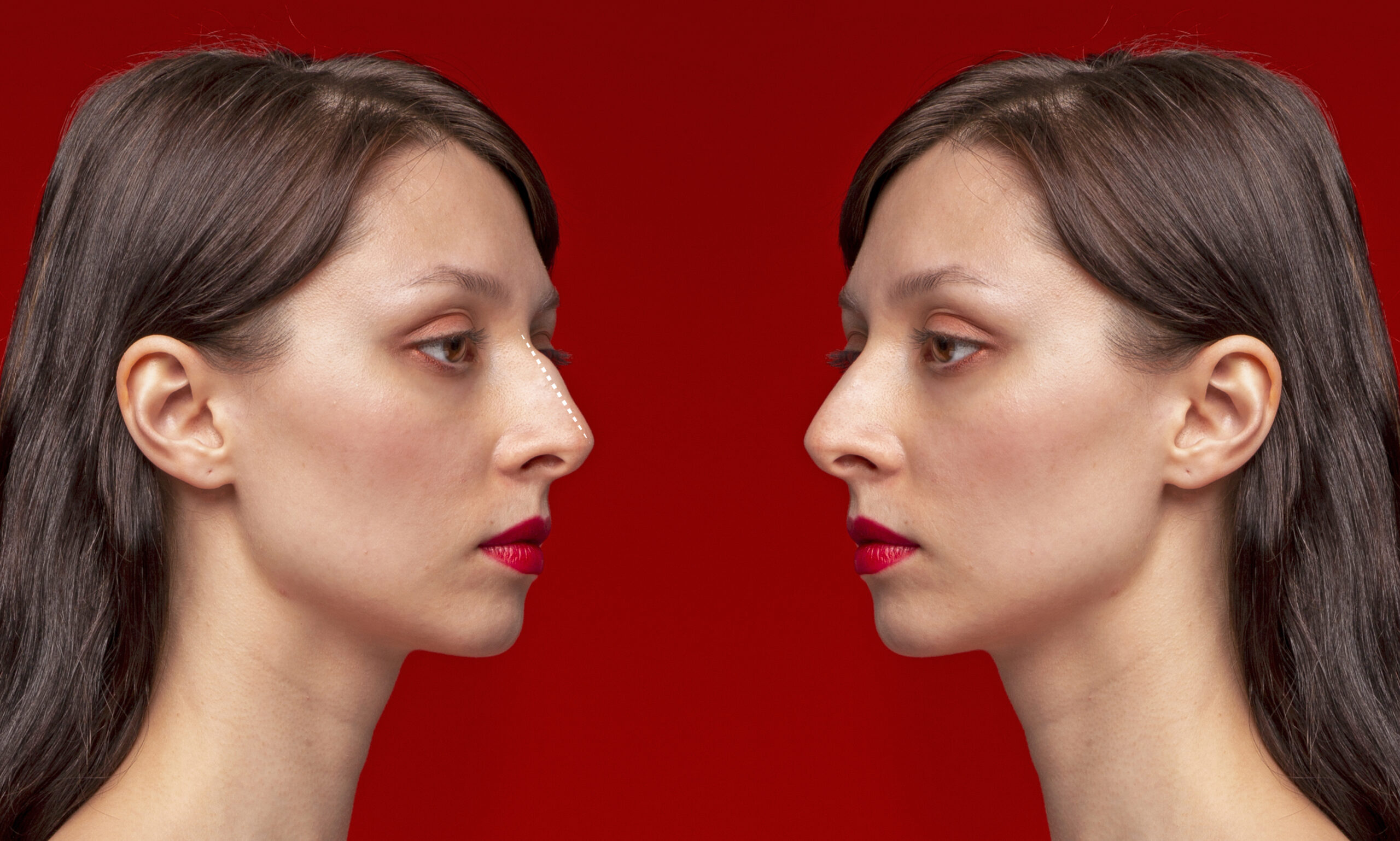 Burun Şekil Bozukluğu Ameliyatı Nedir?