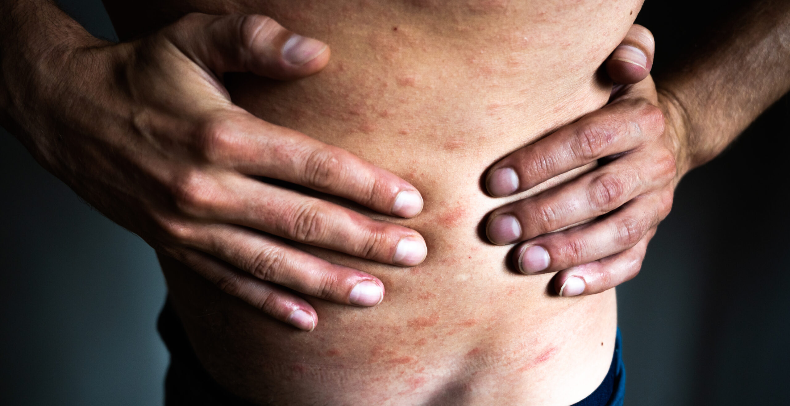 Cüzzam Hastalığı