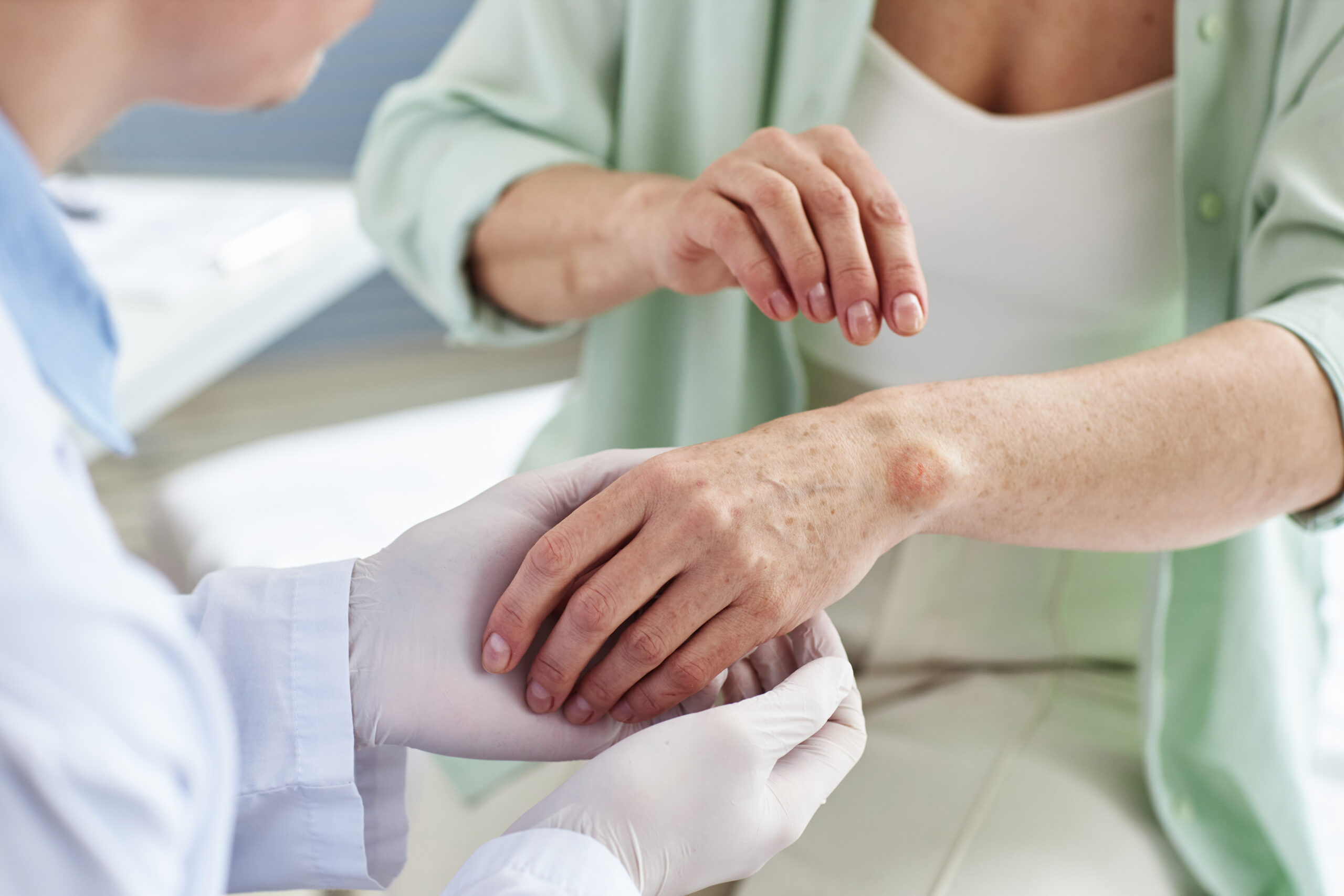 Kelebek Hastalığı – Lupus