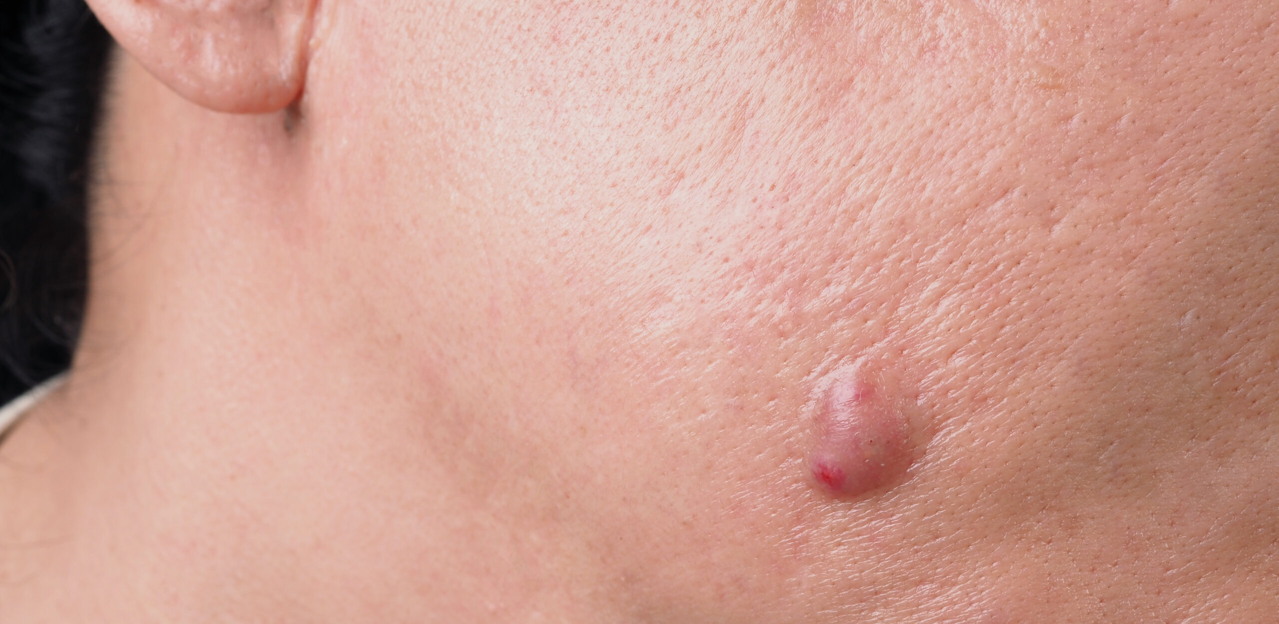 Kıl Dönmesi (Pilonidal Sinüs)