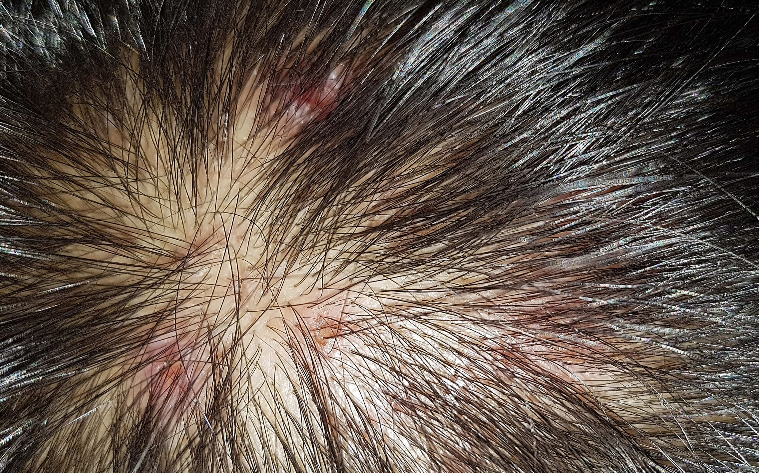 Kıl Kökü İltihabı (Folikülit)