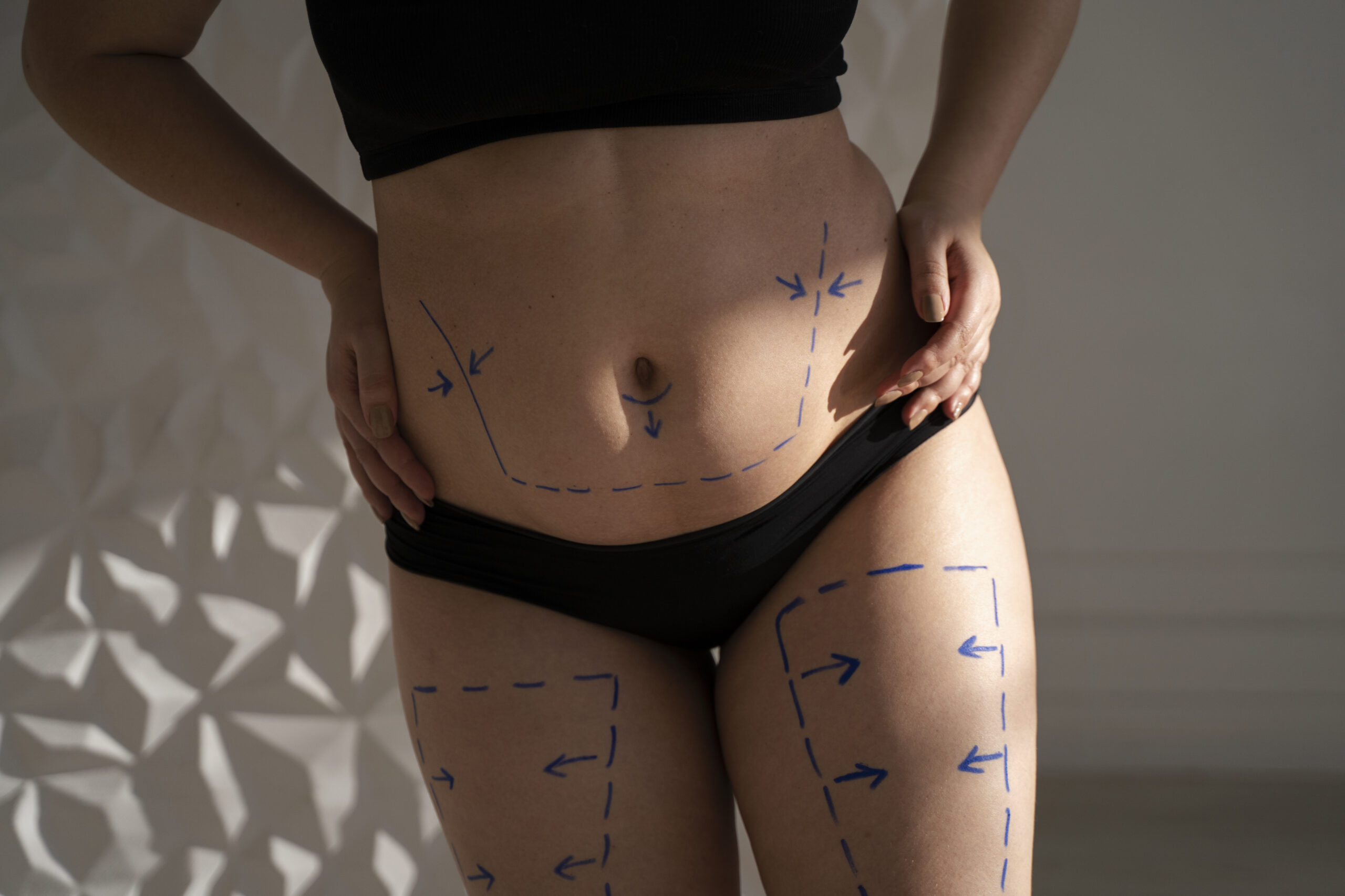 Liposuction (Yağ Aldırma) Ameliyatı