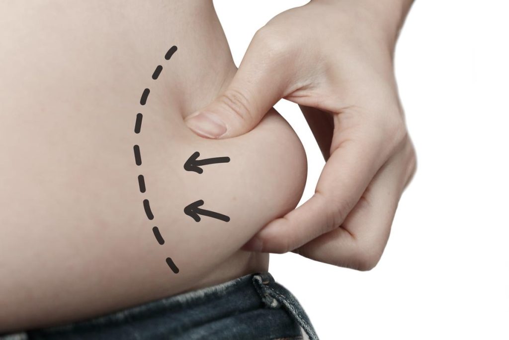 Liposuction - Magnet Hastanesi
