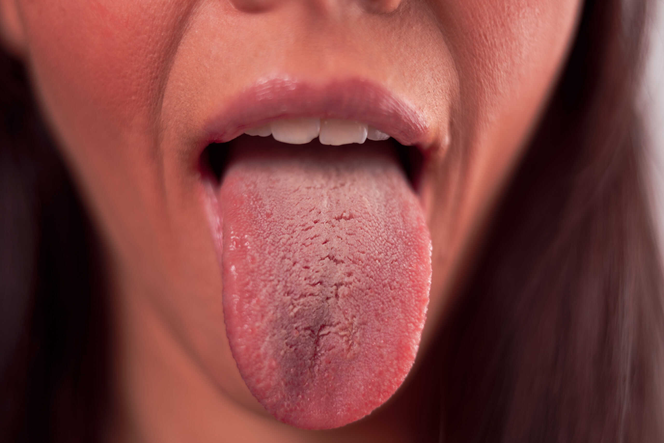 Sjögren Sendromu Nedir? Belirtileri ve Tedavi Seçenekleri