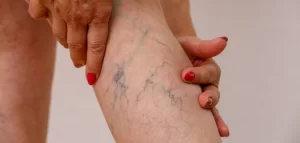 Varis Ameliyatı Nedir?